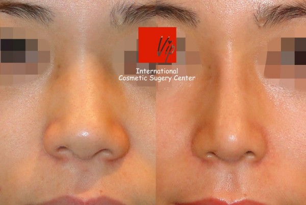 	Nose Surgery, Harmony-Rhinoplasty, Protruded Mouth Correction Rhinoplasty, Rib cartilage Rhinoplasty, Each Cases Nose	 - VIP Harmony rhinoplasty (correction of mid face retrusion & protruded mouth)