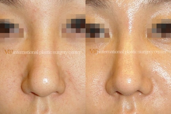 	Nose Surgery	 - Wide nasal bone reduction rhinoplasty