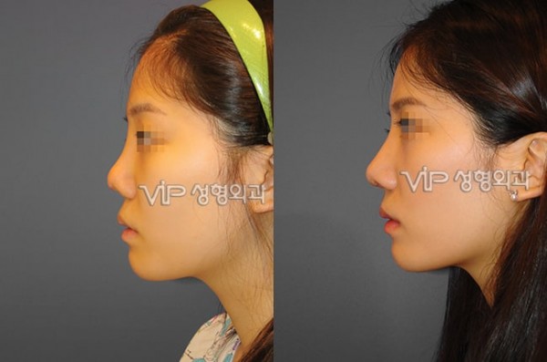 Nose Surgery - Revision rhinoplasty with Septal cartilage