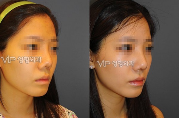 Nose Surgery - Revision rhinoplasty with Septal cartilage