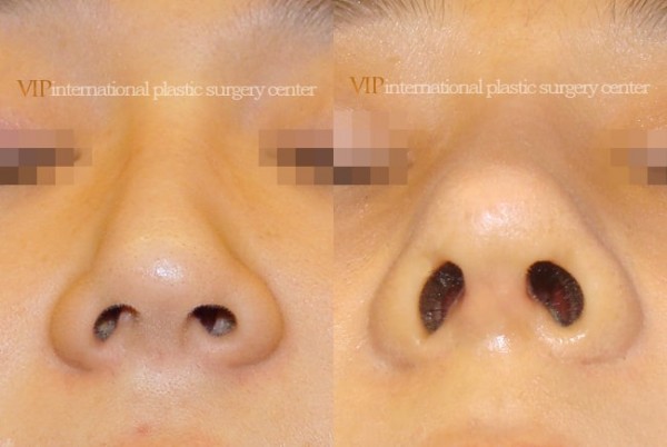 Nose Surgery - Septal cartilage rhinoplasty