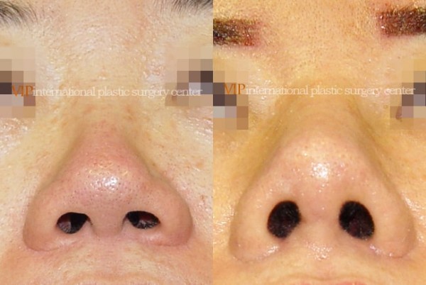 Nose Surgery - Alar base reduction