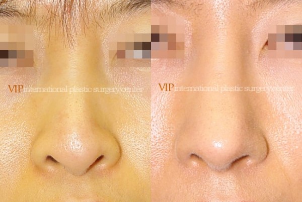 Nose Surgery - Nostril correction