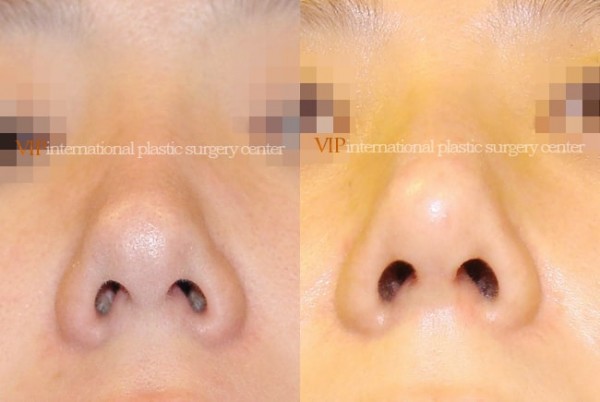 Nose Surgery - Rhinoplasty