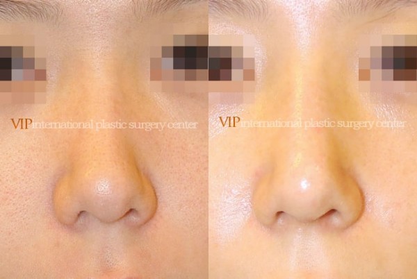 Nose Surgery - Rhinoplasty