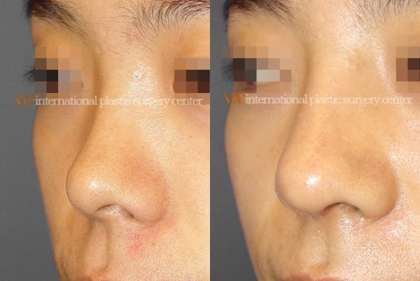 Nose Surgery - Septal deviation correction