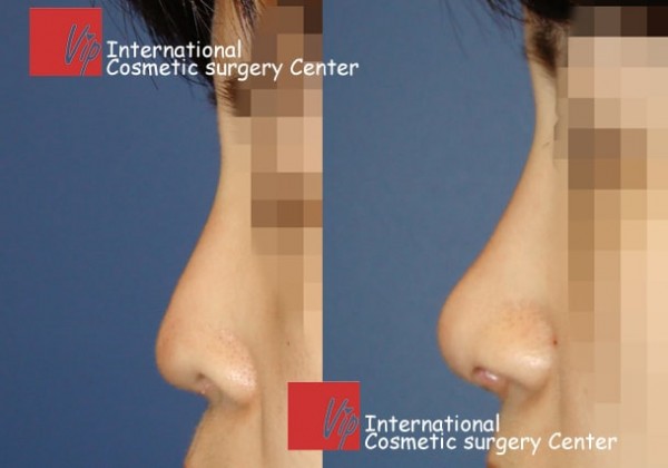 	Nose Surgery, Rib cartilage Rhinoplasty, Revision Rhinoplasty	 - Deviated nose correction