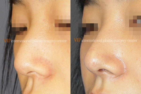 Nose Surgery - Rib cartilage rhinoplasty