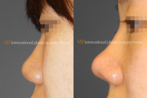 Nose Surgery - Septal cartilage rhinoplasty