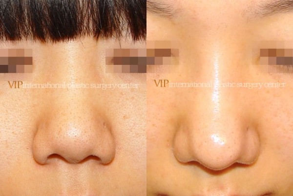 Nose Surgery - Septal cartilage rhinoplasty