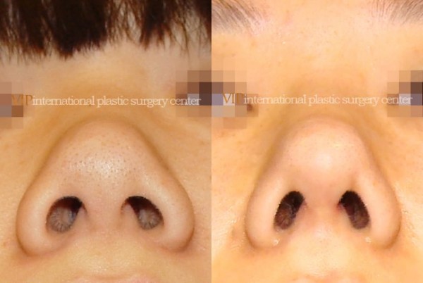 Nose Surgery - Septal cartilage rhinoplasty