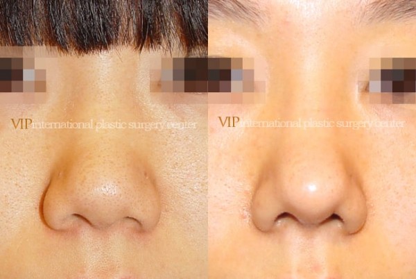 Nose Surgery - Septal cartilage rhinoplasty