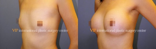 Breast Surgery - Breast surgery