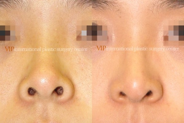 Nose Surgery - Nostril correction