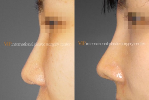 	Nose Surgery	 - Wide nasal bone reduction rhinoplasty