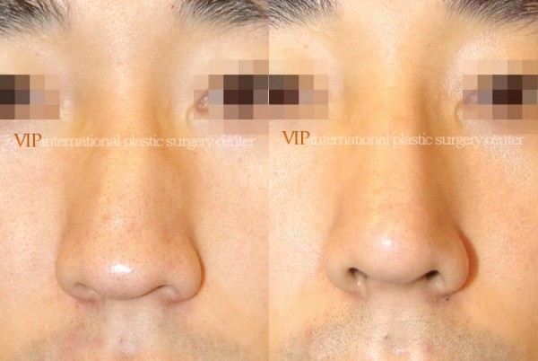 Nose Surgery - Septal deviation & Humped nose correction