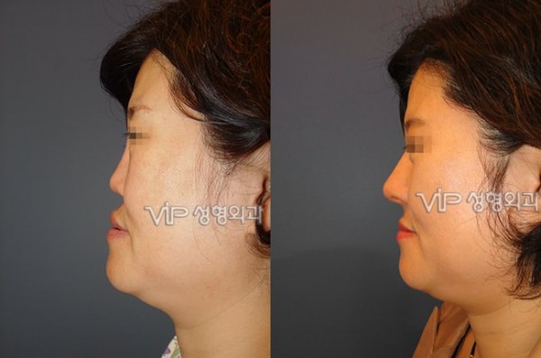 	Harmony-Rhinoplasty, Protruded Mouth Correction Rhinoplasty, Rib cartilage Rhinoplasty	 - Revision- correction of depressed nose with Rib cartilage