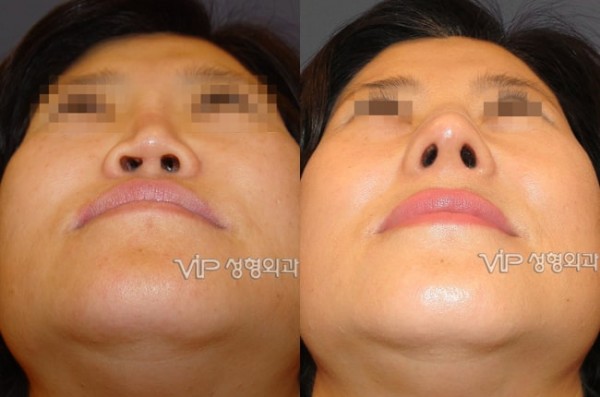 	Harmony-Rhinoplasty, Protruded Mouth Correction Rhinoplasty, Rib cartilage Rhinoplasty	 - Revision- correction of depressed nose with Rib cartilage