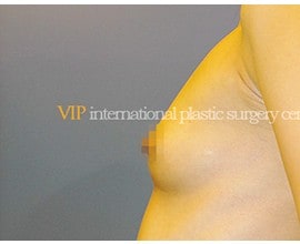 Breast surgery