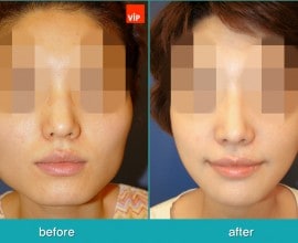 Septal Cartilage Rhinoplasty, Face Contouring Surgery, V-lin…