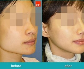 Rhinoplasty and Deviated Septum Surgery, Face Contouring Sur…