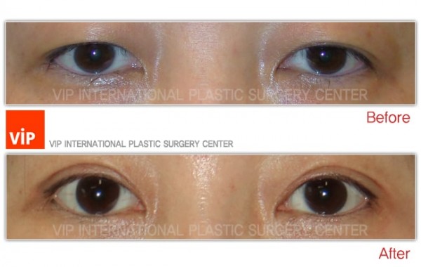 	Eye Surgery, Double Fold, Ptosis Correction	 - Ptosis correction