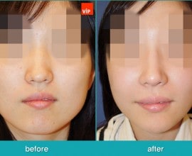 Septorhinoplasty, Face Contouring Surgery, Jawline Reduction…