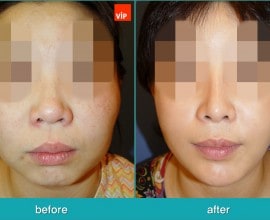 Rib Cartilage Rhinoplasty, Face Contouring Surgery, V-line S…