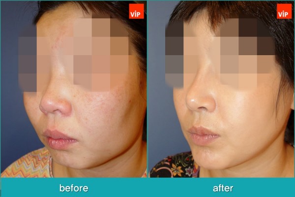 	Nose Surgery, Rib cartilage Rhinoplasty, Facial Bone Surgery, Stem Cell Fat Graft	 - Rib Cartilage Rhinoplasty, Face Contouring Surgery, V-line Surgery, Fat Graft, Cheekbone Reduction