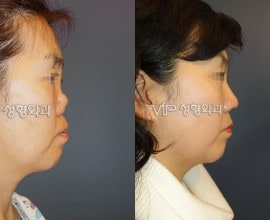 Revision rhinoplasty with Rib cartilage -Collapsed by silico…
