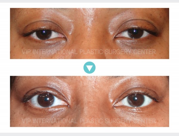 Eye Surgery - Ptosis Correction