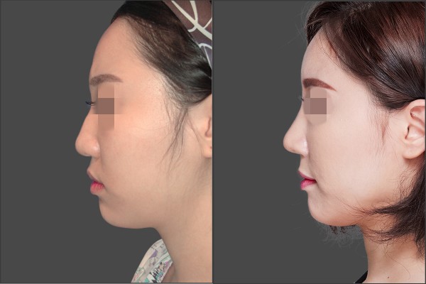 Nose Surgery, Stem Cell Fat Graft - Combination Rhinoplasty, Fat graft