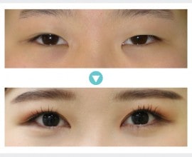 Ptosis Correction