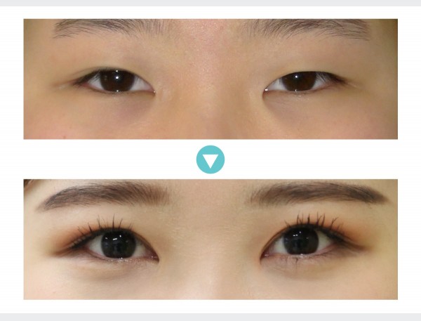 Eye Surgery - Ptosis Correction