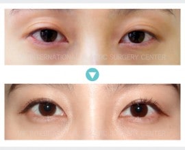 Ptosis Correction