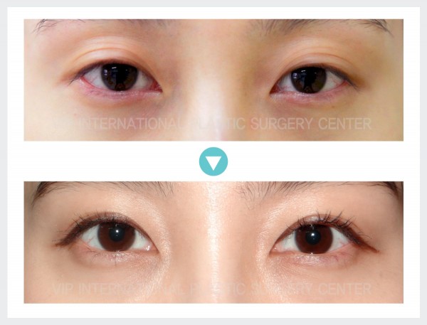 Eye Surgery - Ptosis Correction