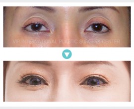 Ptosis Correction, Upper Eyelid Fat graft