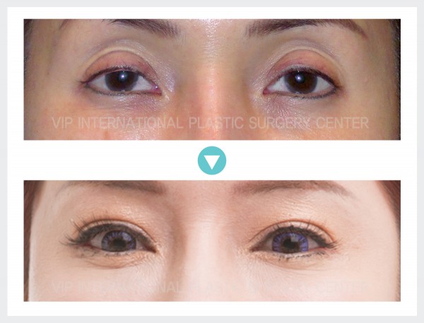 Eye Surgery - Ptosis Correction, Upper Eyelid Fat graft