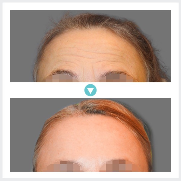 Face Lift - Endoscopic Forehead Lift