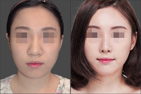 Nose Surgery, Stem Cell Fat Graft - Combination Rhinoplasty, Fat graft