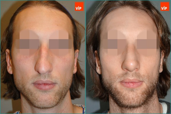 Nose Surgery - Septal cartilage rhinoplasty, Hump Nose