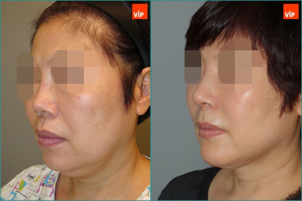 Nose Surgery, Face Lift - Rib cartilage rhinoplasty