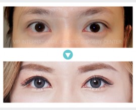 Incision Double Eyelid Surgery
