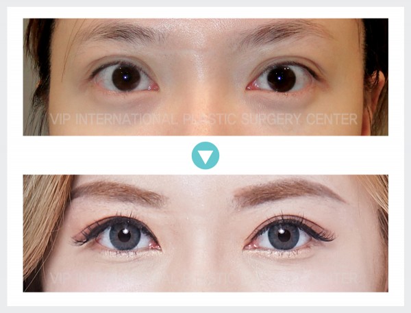 Eye Surgery - Incision Double Eyelid Surgery