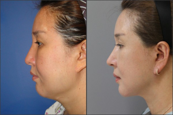 Nose Surgery, Face Lift - facelift , septal rhinoplasty