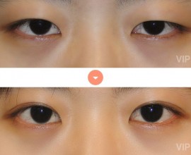 Double Eyelid Surgery