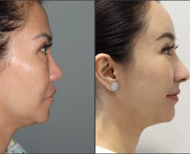 Rib cartilage Rhinoplasty, Endoscopic Forehead Lift, Fat gra…