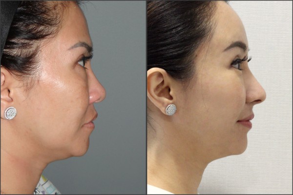 Nose Surgery, Face Lift, Stem Cell Fat Graft - Rib cartilage Rhinoplasty, Endoscopic Forehead Lift, Fat graft, Lateral Canthoplasty