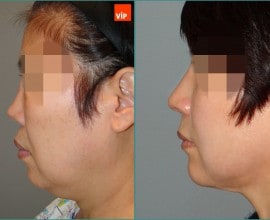 Rib cartilage rhinoplasty