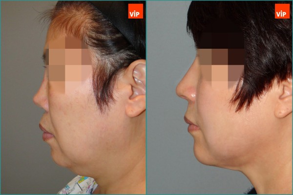 Nose Surgery, Face Lift - Rib cartilage rhinoplasty